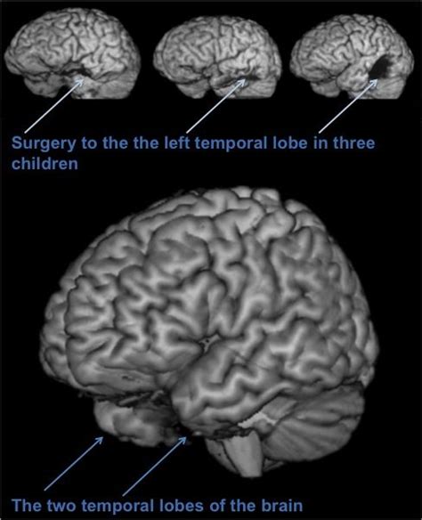 #Brain function and brain surgery in children with #epilepsy Epilepsy Surgery, Operation, Brain ...