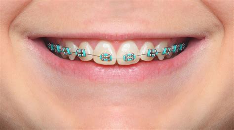 Color wheel for braces color wheel for braces - holisticplm