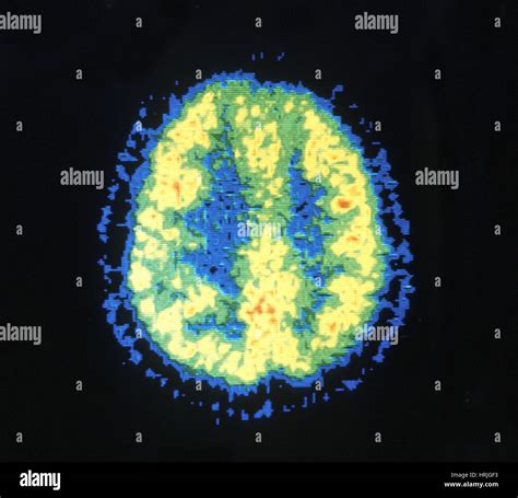 Pet Scan Brain High Resolution Stock Photography and Images - Alamy