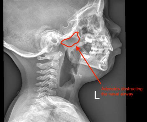 Adenoid Hypertrophy X Ray