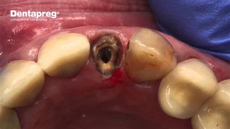 How To Fix A Broken Tooth Crown At Home | Review Home Co