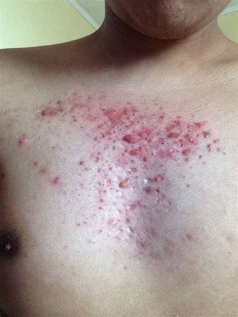 Please help me treat my severe chest acne. – General acne discussion – Acne.org Forum