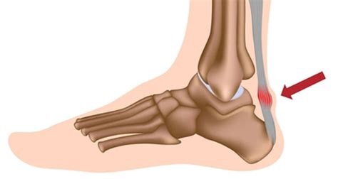 Achilles Bursitis | Retrocalcaneal Bursitis - Symptoms, Causes & Treatment