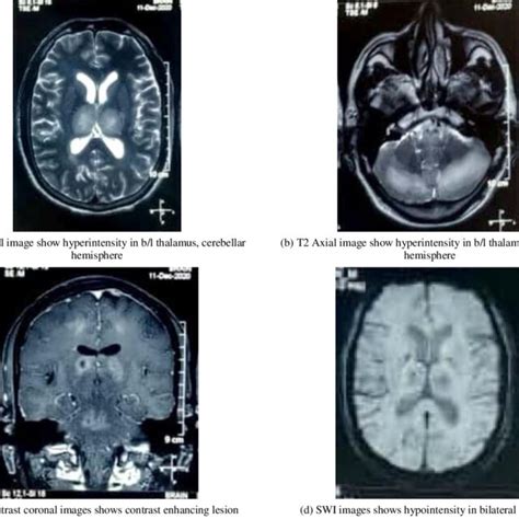 [Patient 30-Left Optic neuritis]: MRI T2/FLAIR coronal image shows... | Download Scientific Diagram