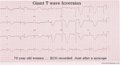 giant t wave inversion | Dr.S.Venkatesan MD