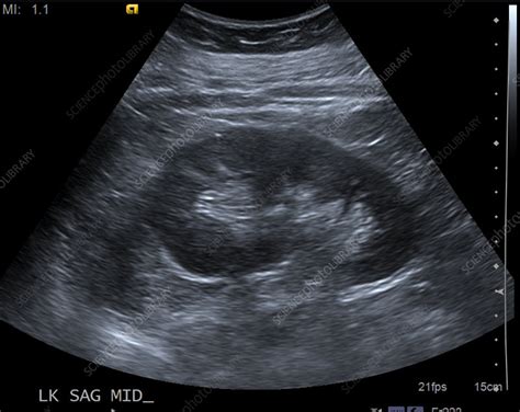 Normal Kidney Size Ultrasound