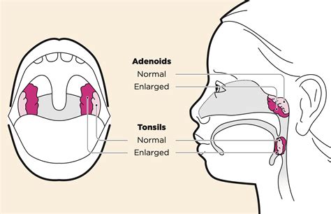 Tonsils and Adenoids - Upopolis