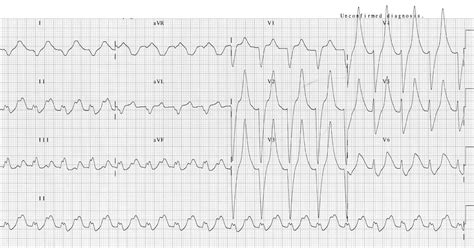 Hyperkalemia