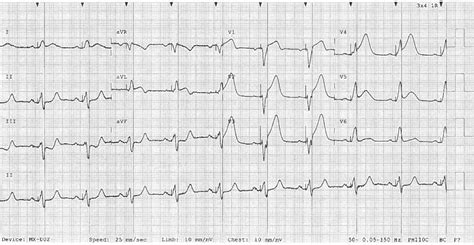 Lbbb Stemi Criteria