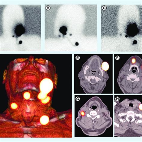 Mobile-camera detection of the sentinel lymph node(s) during sentinel... | Download High-Quality ...