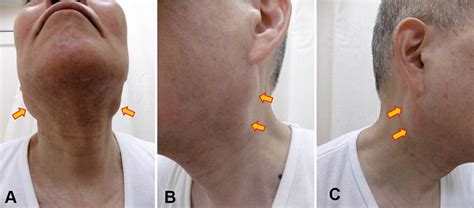 Lymphoepithelial Cysts