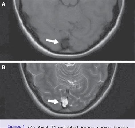 Figure 1 from Giant arachnoid granulation mimicking dural sinus thrombosis | Semantic Scholar