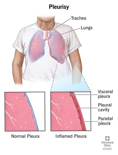 Pleurisy: Causes, Symptoms, Diagnosis, Treatment & Prevention