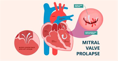 Mitral Valve Prolapse: Symptoms, Diagnosis, and Treatment | Oklahoma ...