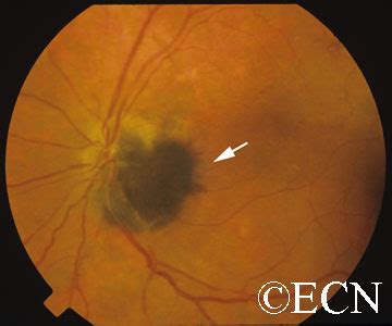 Optic Nerve Melanocytoma » New York Eye Cancer Center