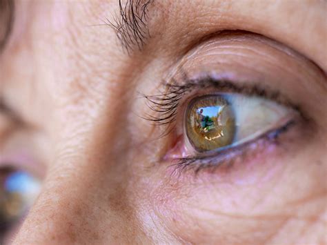 Melanoma in the Eye: Symptoms, Causes, Diagnosis, Treatment