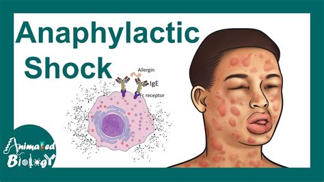 Anaphylactic Shock (Anaphylaxis) Treatment, Nursing, 56% OFF