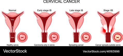 Cervical cancer stages of a carcinoma cervix Vector Image