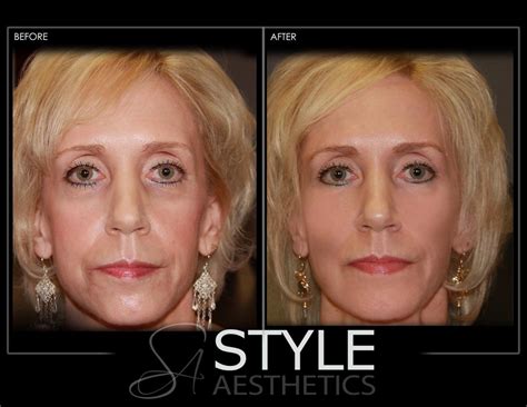 Liquid-Facelift-Face-Lift-Before-After-Photos-Portland-Oregon-0417 - Style Aesthetics by RajaniMD