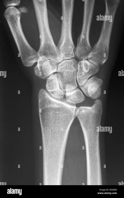 X Ray Hand Bones