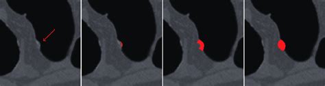 The VOI extraction for a 6 mm sessile polyp in a sigmoid colon. a) The... | Download Scientific ...