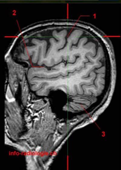 Central Sulcus - Definition, Location (MRI) and Function - (updated in ...