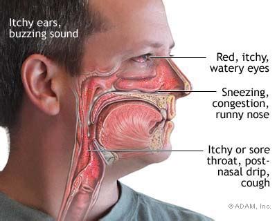 Post Nasal Drip - Cough, Sore Throat, Symptoms, Causes, Treatment and ...