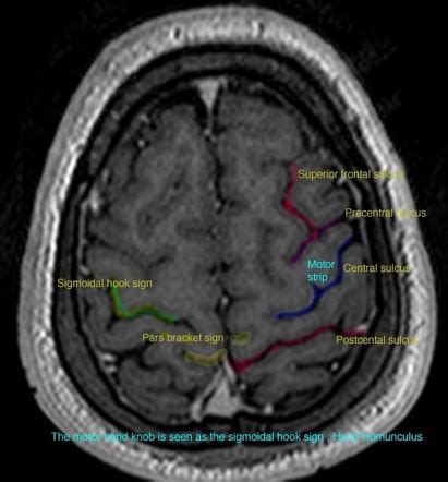 Central sulcus | Radiology Reference Article | Radiopaedia.org