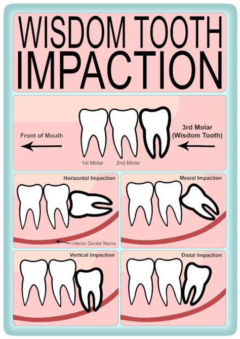 Food Timeline After Wisdom Teeth Removal - TeethWalls