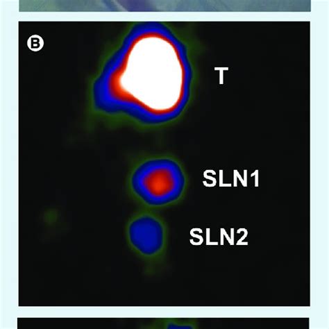 Sentinel lymph node identification using lymphoscintigraphy and... | Download Scientific Diagram