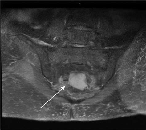 -Coronal T2-weighted Fat Sat MRI image of the sacrum demonstrating bone... | Download Scientific ...