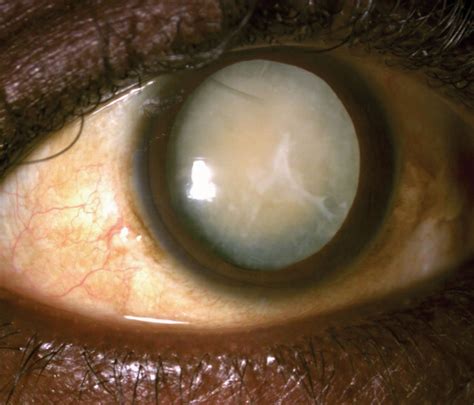 Cataract - Nurses Revision