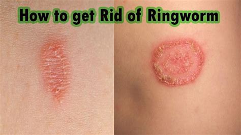 Defeating Ringworm - Tracy Wrestling Club