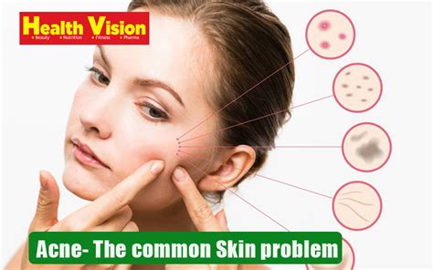 Acne – The common skin problem - Health Vision