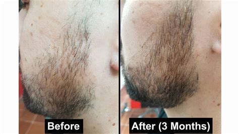 slsi.lk - how long for sulfatrim to work | How to apply rogaine on beard simply