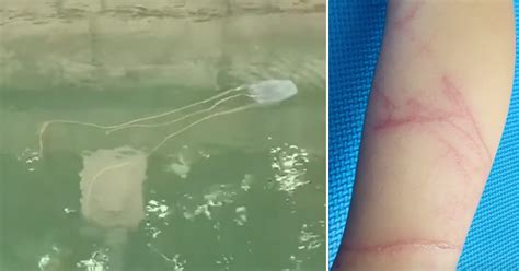 What to do if you're stung by a box jellyfish in S'pore: Don't pee on stings, call 995 ...