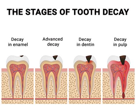 Tooth Decay Treatment - TheDentech.com