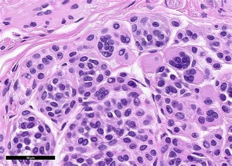 Nevus Comedonicus Histology