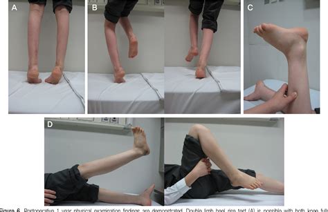 Figure 1 from Treatment of Calcaneovalgus Deformity Following Operative Treatment of Diplegic ...