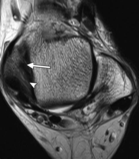 MR Imaging of Deltoid Ligament Pathologic Findings and Associated Impingement Syndromes ...