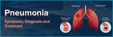 Pneumonia: Cause, Symptoms, Diagnosis and Treatment