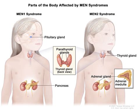 Childhood Multiple Endocrine Neoplasia (MEN) Syndromes Treatment - NCI