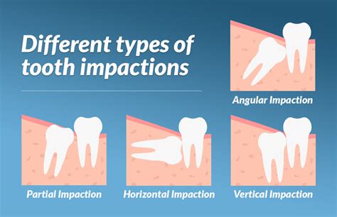 Wisdom Tooth Removal | Neutral Bay Dentist