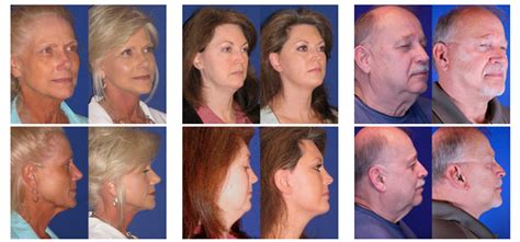 Comparing SMAS Facelift Options for Nashville | Youthful Reflections