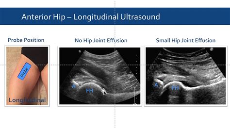 Anterior Hip Joint Ultrasound