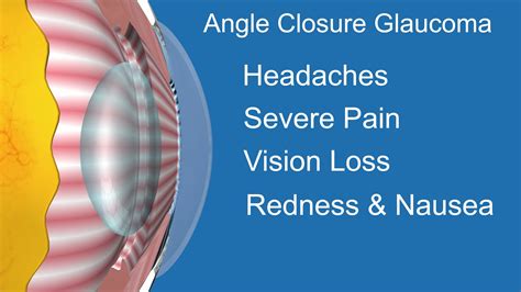 Acute Angle Glaucoma Symptoms