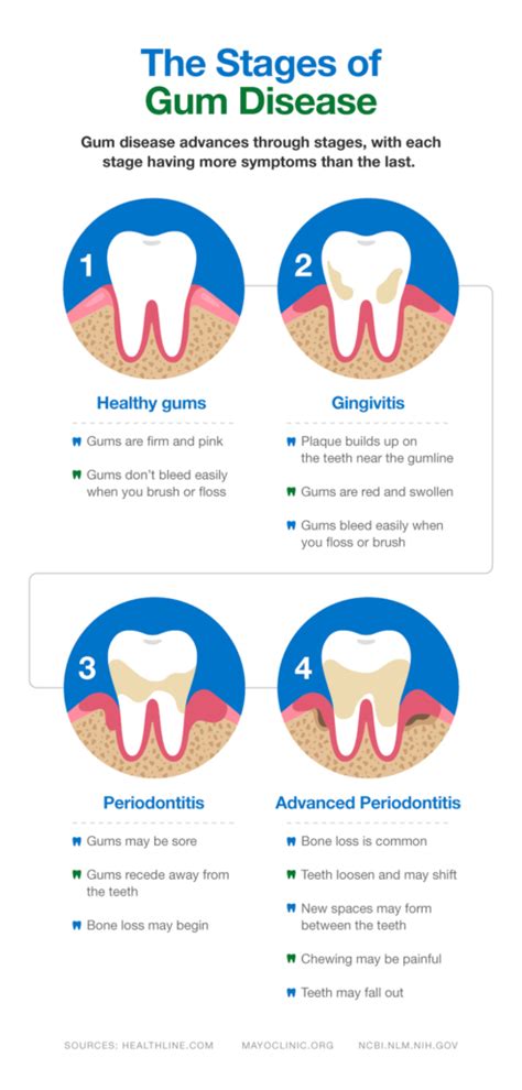 What Causes Periodontitis and How to Treat It - SmartMouth