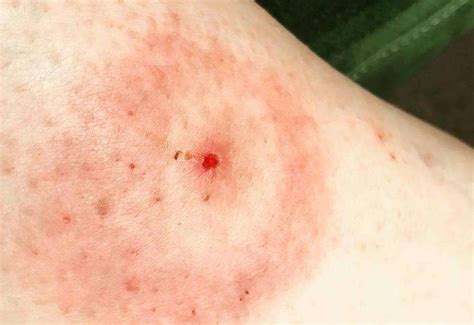 Sufferers of Lyme disease speak out after tick bites