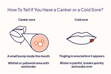 Canker Sore Vs Cold Sore Inside Lip