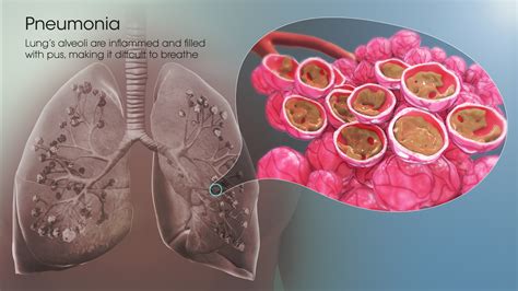 Pneumonia - Scientific Animations